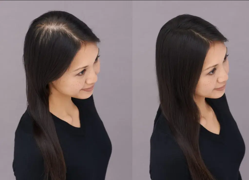 Thinning Hair? Minoxidil for Women Can Help Restore It