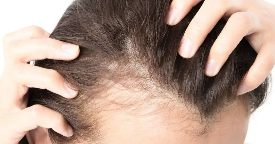 Oral vs Topical Minoxidil: Which One Should You Use?